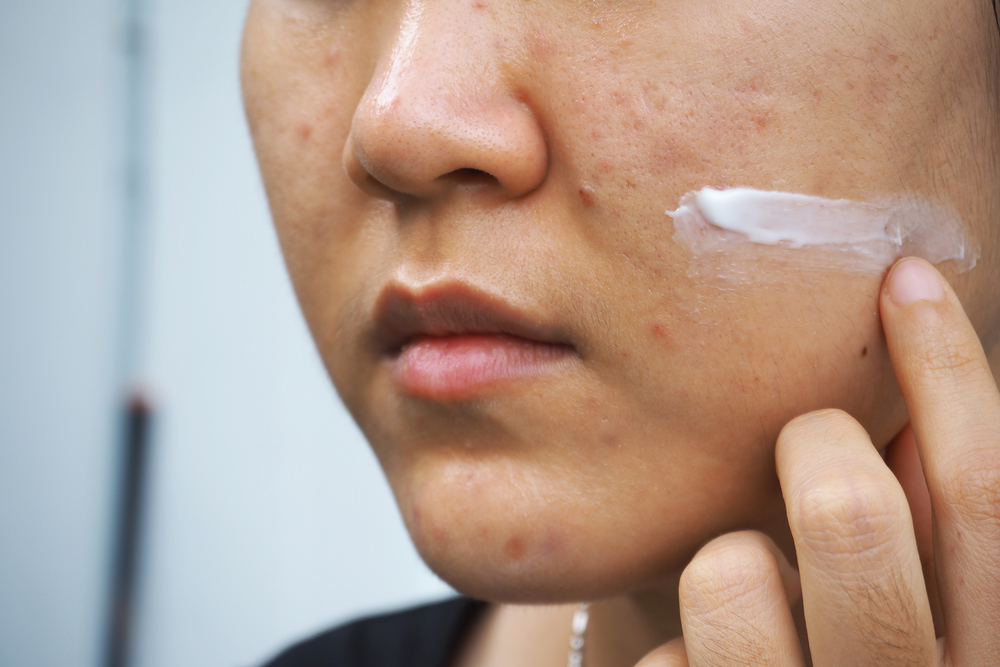 woman applying cream on skin purging face